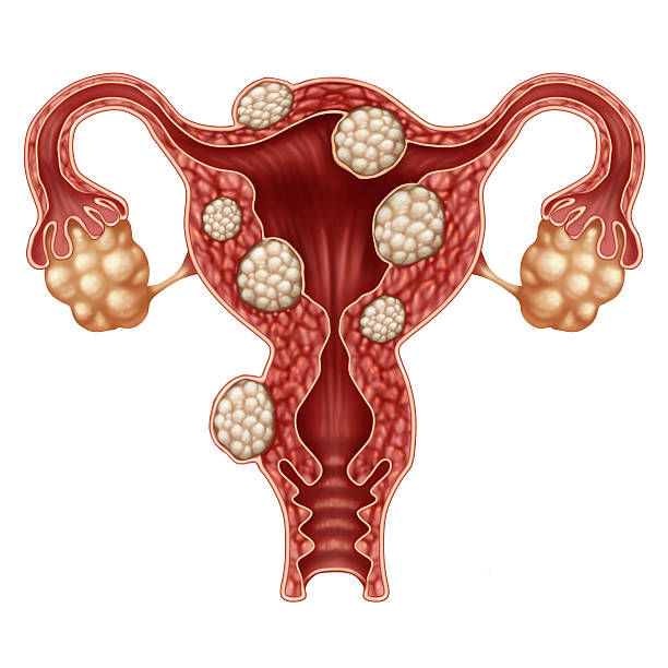 Uterine Fibroids